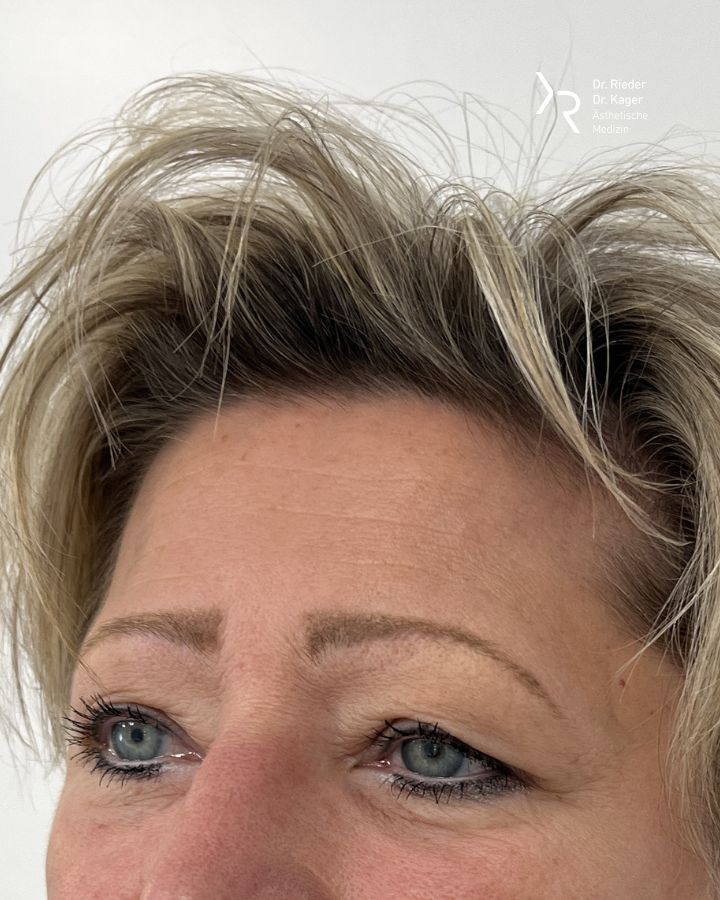Oberlidstraffung - Vorher/Nachher Vergleich - Vorher