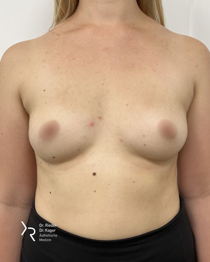 Brustvergrößerung - Vorher/Nachher Vergleich - Vorher