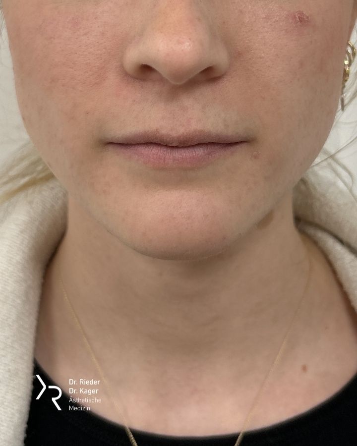 Lippenkorrektur - Vorher/Nachher Vergleich - Vorher