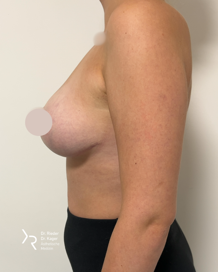 Bruststraffung mit oder ohne Implantat – Vorher/Nachher Vergleich - Nachher