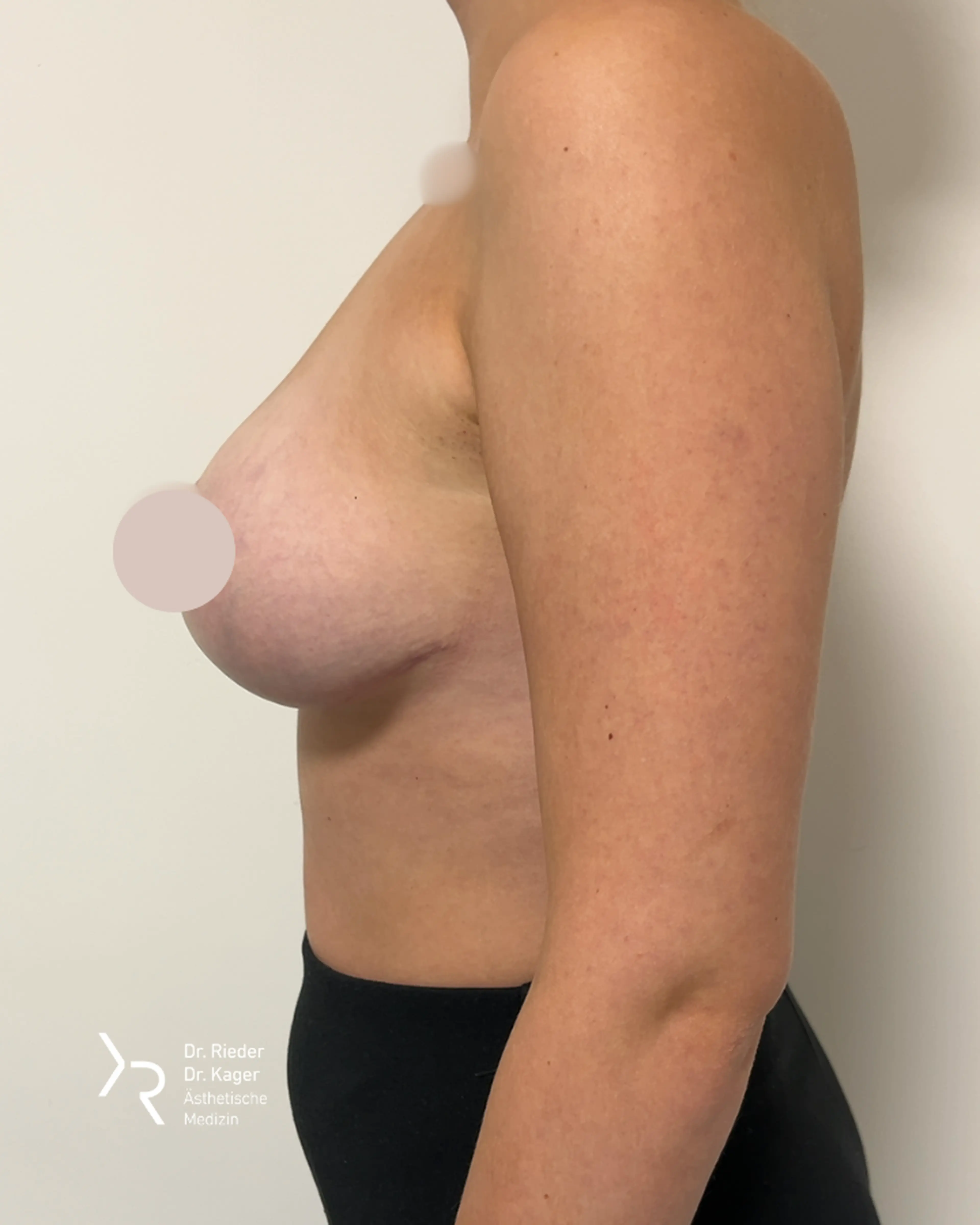 Bruststraffung mit oder ohne Implantat - Vorher/Nachher Vergleich - Nachher