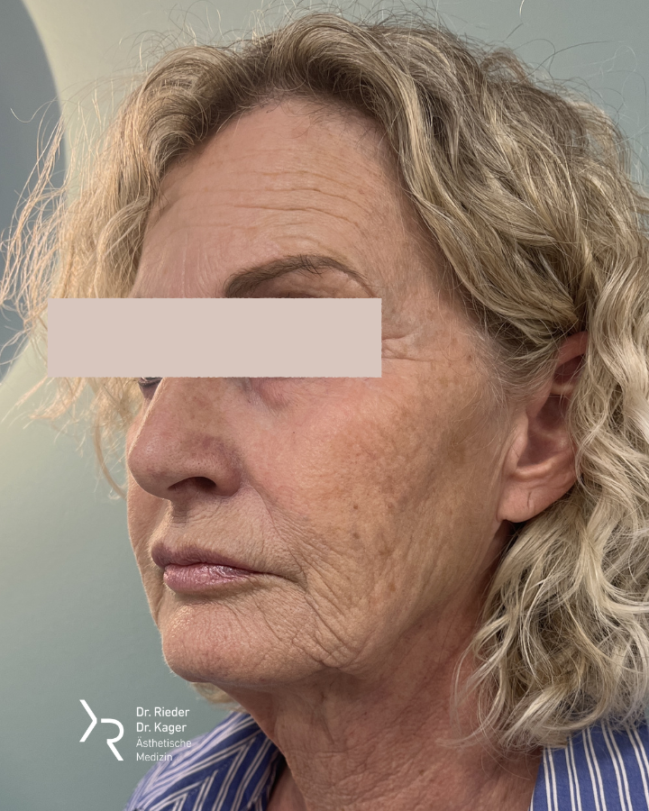Großes Facelift - Vorher/Nachher Vergleich - Vorher