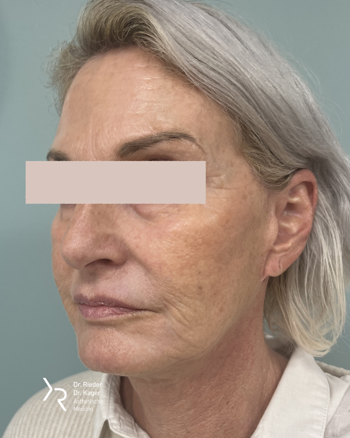 Großes Facelift - Vorher/Nachher Vergleich - Nachher