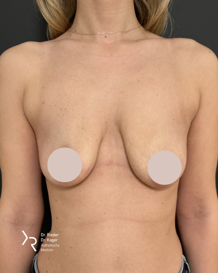 Bruststraffung mit oder ohne Implantat – Vorher/Nachher Vergleich - Vorher