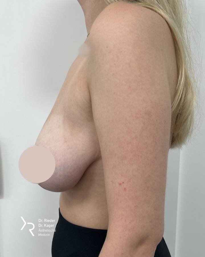 Bruststraffung mit oder ohne Implantat – Vorher/Nachher Vergleich - Vorher