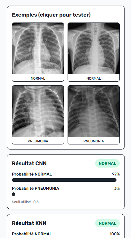 AI Pneumonia Detector - Aperçu 2