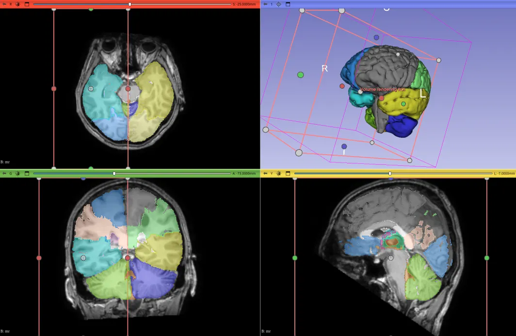 3D Pre-Operative Visualisation Tool