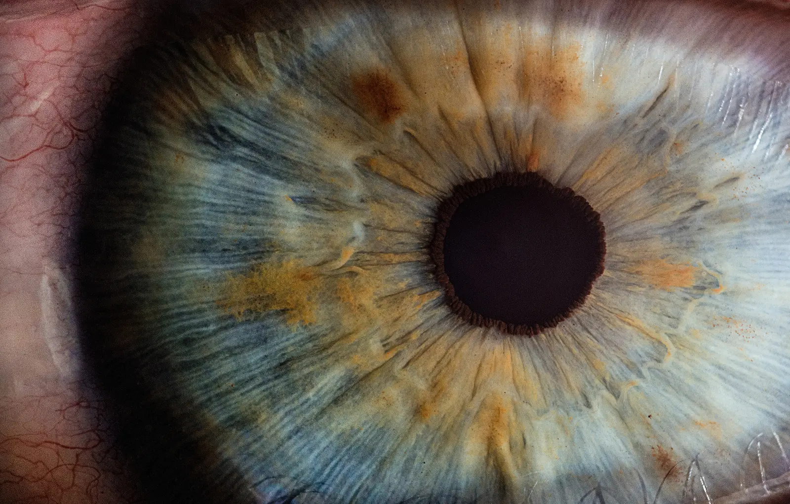Pupillary contagion in Williams syndrome
