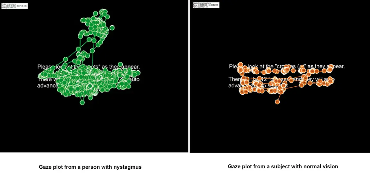 The figures illustrate how differently a person with nystagmus reads as compared to a subject with normal vision. 