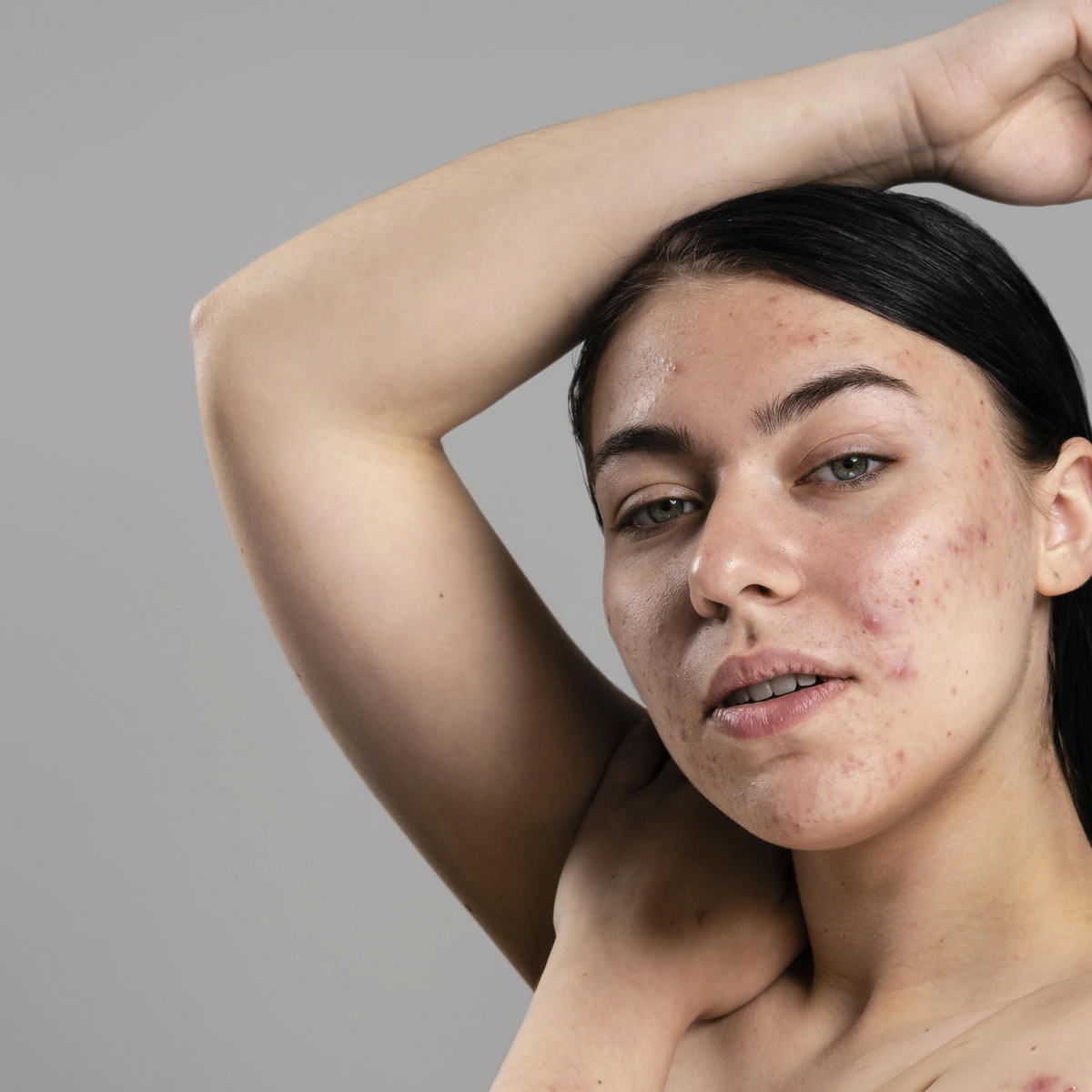 Header - acne - huid - puistjes - pose - model - skincare - haar - beauty - Freepik