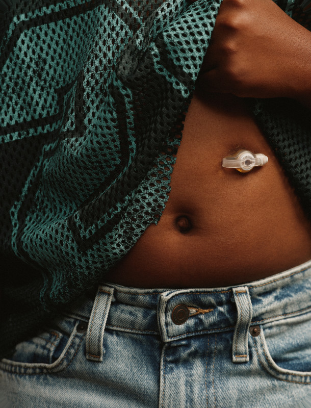 A person showing their feeding tube