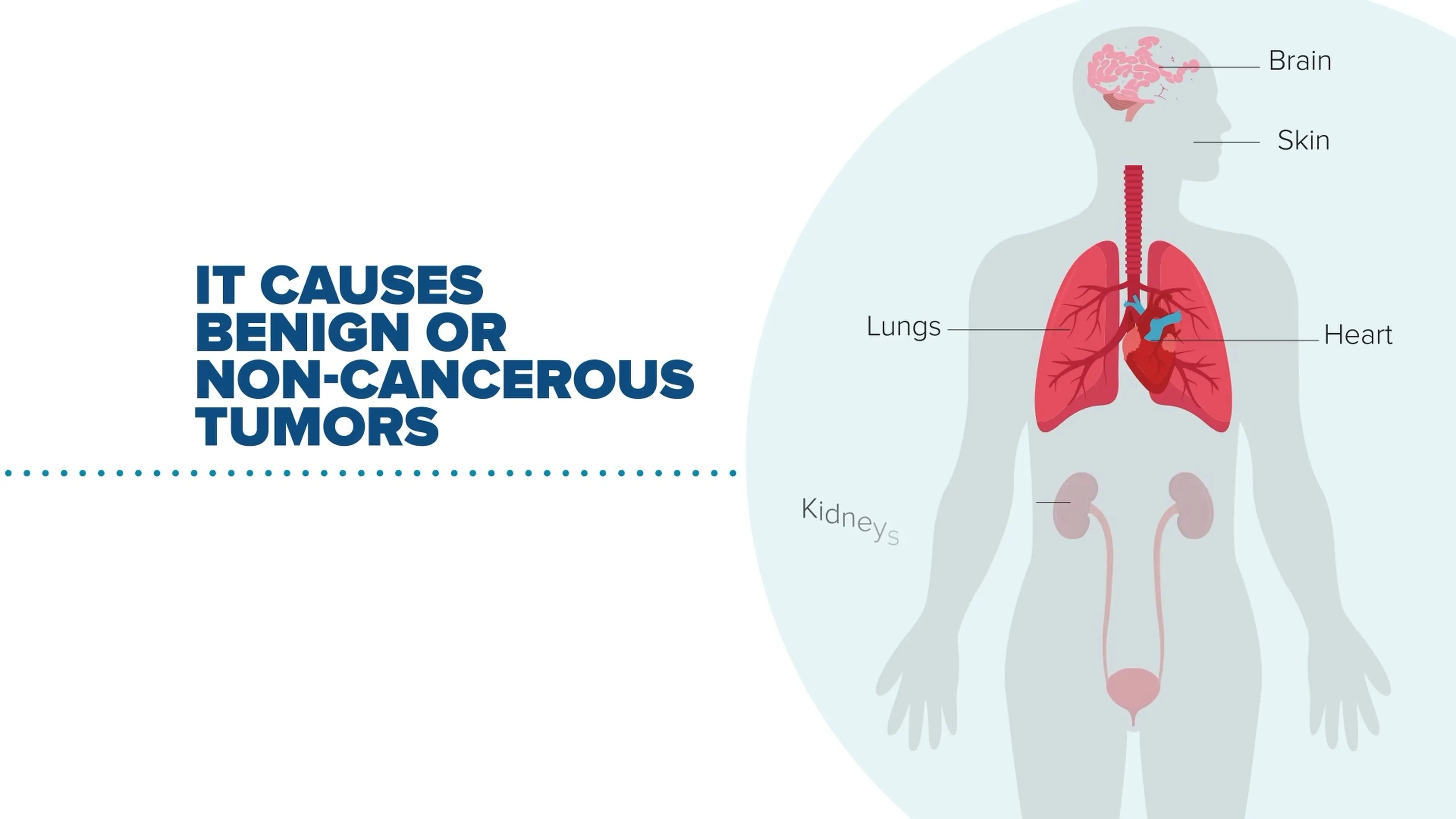 Anatomical diagram of the human body with brain, skin, lungs, heart and kidneys labeled, from a Motifmotion medical animation for NobelPharma