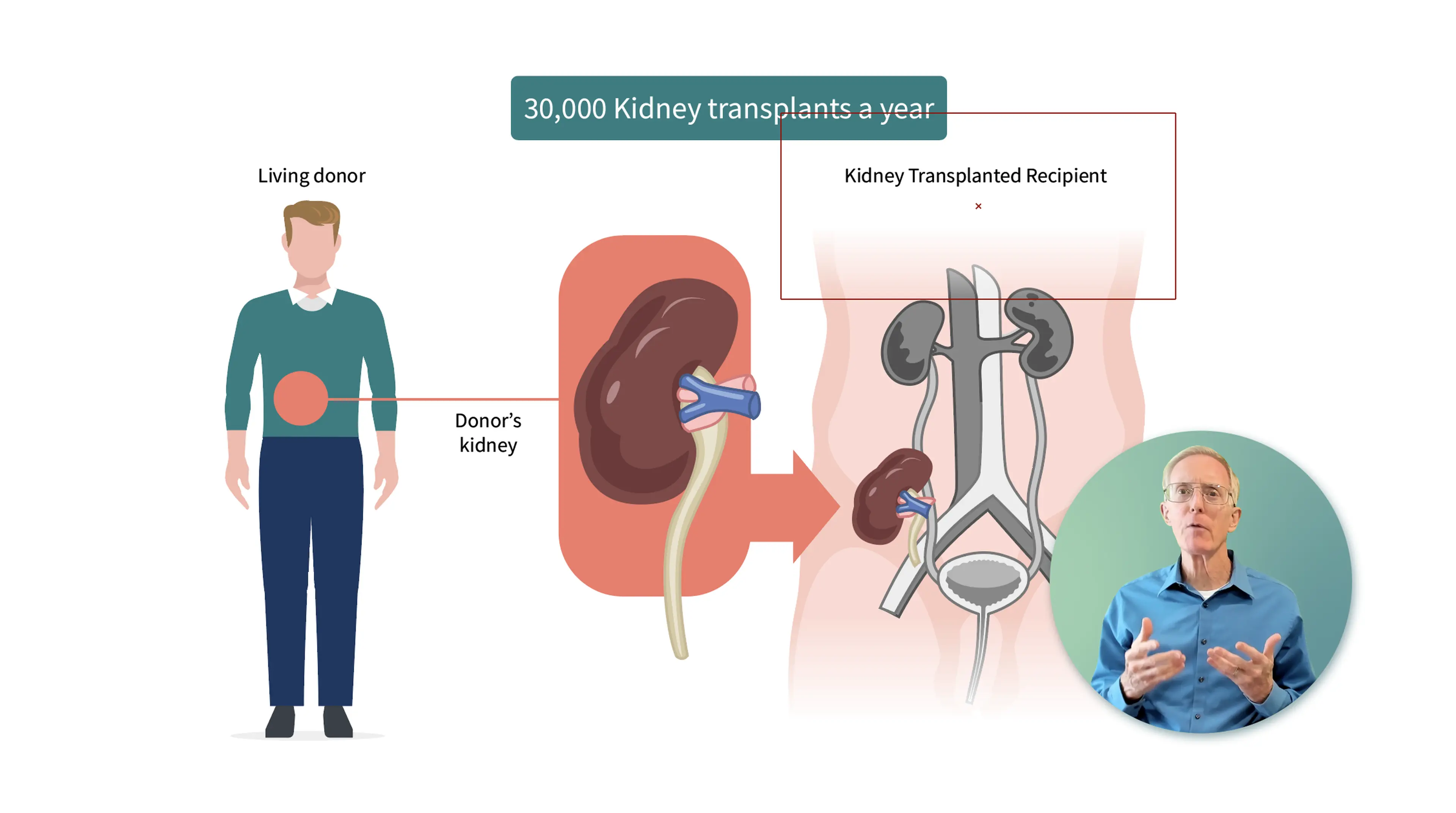 Animated kidney transplant diagram showing living donor to recipient, with a live presenter overlay