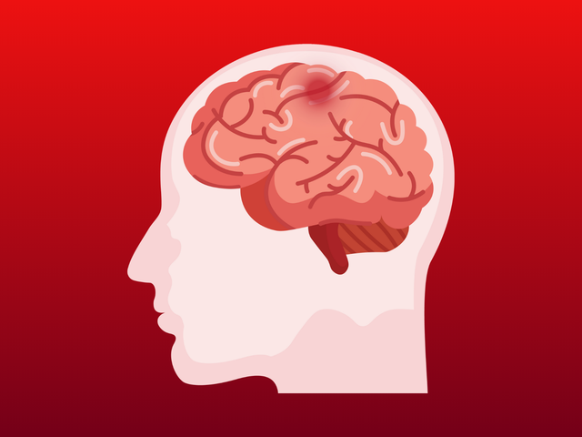 Stroke Awareness Blog Banner