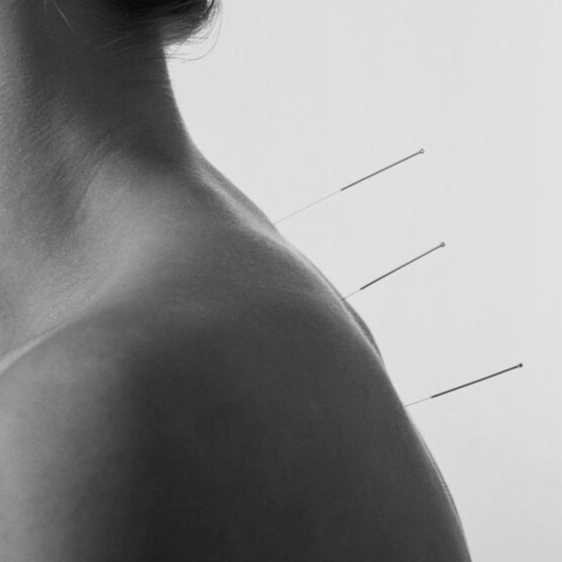 Acupuncture needles placed along the neck and shoulder during treatment