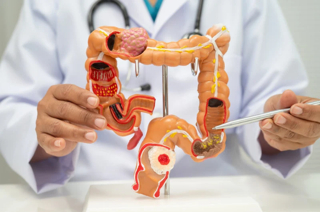 Colon cancer