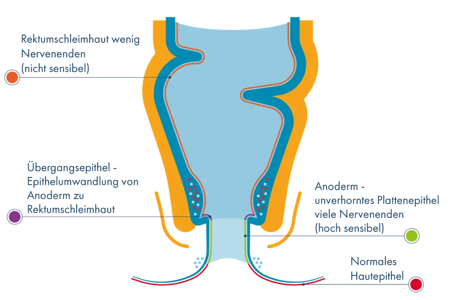 Anatomische Querschnitts-Illustration des Analkanals mit Beschriftung der Gewebezonen: Oben die wenig sensible Rektumschleimhaut, gefolgt vom Übergangsepithel, dem hochsensiblen Anoderm (viele Nervenenden) und dem äußeren normalen Hautepithel.
