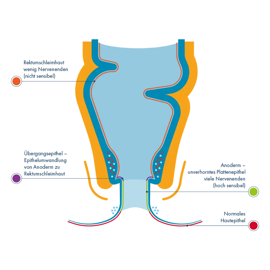 Anatomische Querschnitts-Illustration des Analkanals mit Beschriftung der Gewebezonen: Oben die wenig sensible Rektumschleimhaut, gefolgt vom Übergangsepithel, dem hochsensiblen Anoderm (viele Nervenenden) und dem äußeren normalen Hautepithel.