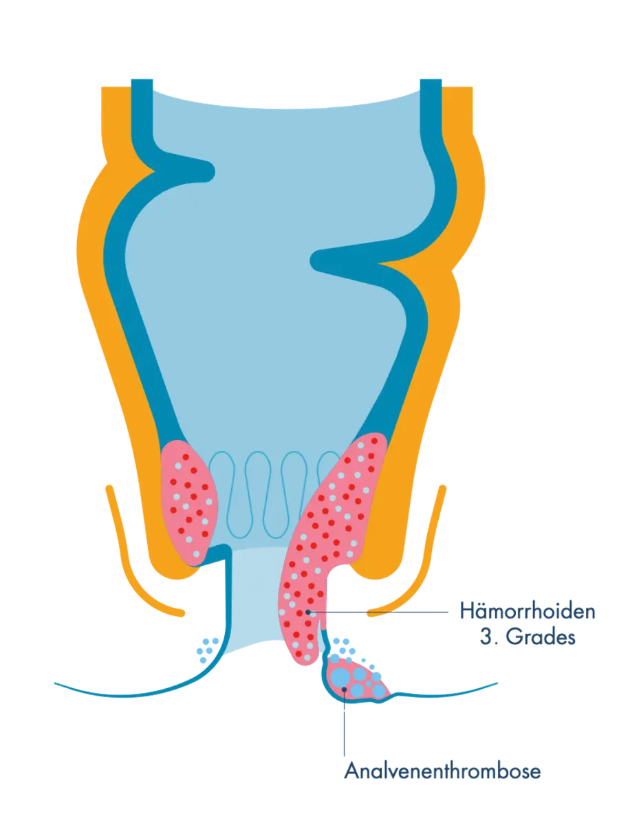 Anatomischer Querschnitt des Analkanals zum Vergleich von Hämorrhoiden 3. Grades (stark vergrößerte, aus dem After herausragende Gefäßpolster) und einer Analvenenthrombose (geröteter, hervorgetretener Knoten am Ausgang des Afters).