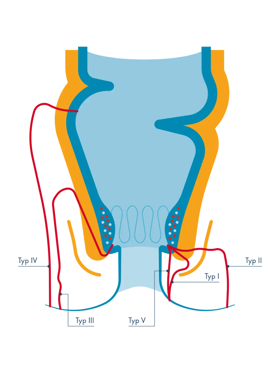 Medizinische Illustration der kryptoglandulären Analfisteltypen nach Parks im Querschnitt des Analkanals; rote Linien zeigen den Verlauf im Verhältnis zum Schließmuskel: Typ I (zwischen den Muskeln), Typ II (quer hindurch), Typ III (über den Muskel hinweg), Typ IV (außen am Schließmuskel vorbei) und Typ V (oberflächlich unter der Haut).