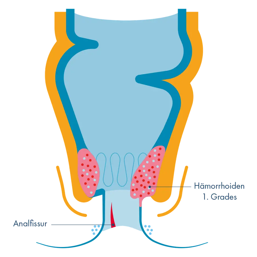 Anatomischer Querschnitt des Analkanals mit zwei markierten Befunden: Rötlich punktierte, leicht vergrößerte Gefäßpolster („Hämorrhoiden 1. Grades“) sowie ein vertikaler roter Einriss am Ausgang („Analfissur“).
