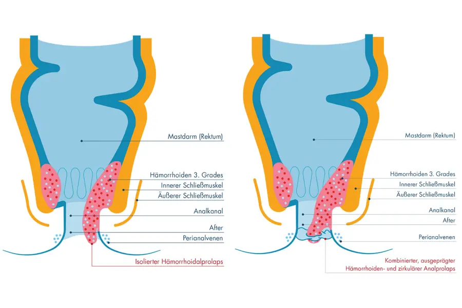 Zwei anatomische Querschnitte des Enddarms im Vergleich: Links ragen stark vergrößerte Hämorrhoiden 3. Grades als isolierter Hämorrhoidalprolaps aus dem Kanal heraus. Rechts ragen vergrößerte Gefäßpolster und ringförmig vorgefallene Schleimhaut als kombinierter Hämorrhoiden- und zirkulärer Analprolaps aus dem After heraus.