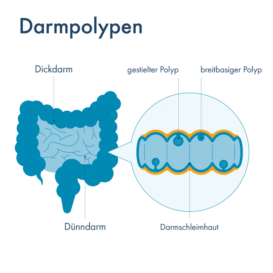 Infografik zu Darmpolypen: Links eine Illustration von Dick- und Dünndarm, rechts eine vergrößerte Querschnittansicht der Darmschleimhaut mit zwei Polypenformen – gestielter Polyp (mit schmalem Stiel) und breitbasiger Polyp (flach aufsitzend).
