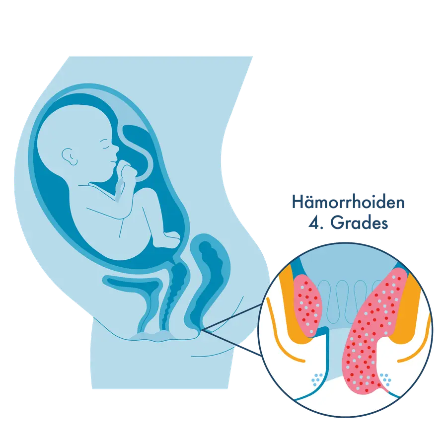 Medizinische Illustration: Links ein Querschnitt eines schwangeren Bauches mit dem Kind im Mutterleib. Rechts eine Vergrößerung des Analkanals mit dauerhaft aus dem After herausragenden, nicht mehr zurückdrückbaren Gefäßpolstern, beschriftet als „Hämorrhoiden 4. Grades".