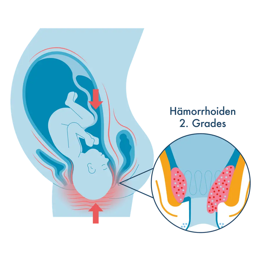 Medizinische Illustration: Links ein Querschnitt eines schwangeren Bauches, rote Pfeile zeigen den Druck des Kindes auf den Beckenboden. Rechts eine Vergrößerung des Analkanals mit vergrößerten, rötlich punktierten Gefäßpolstern, beschriftet als „Hämorrhoiden 2. Grades".