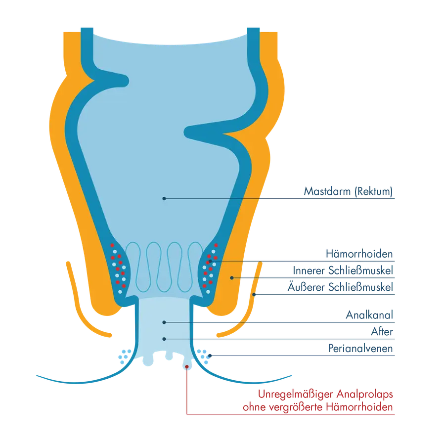 Anatomischer Querschnitt des Enddarms mit Beschriftung von Mastdarm, Hämorrhoiden, innerem und äußerem Schließmuskel sowie dem Analkanal. Am Ausgang ist ein „unregelmäßiger Analprolaps ohne vergrößerte Hämorrhoiden“ markiert, bei dem die Schleimhaut leicht nach außen tritt.
