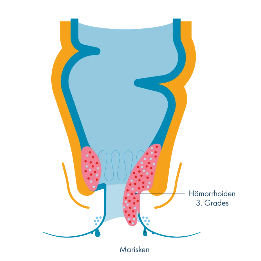 Anatomischer Querschnitt des Analkanals zum Vergleich von Hämorrhoiden 3. Grades (vergrößerte, aus dem After herausragende Gefäßpolster) und Marisken (hautfaltige Ausstülpungen am Ausgang des Afters).