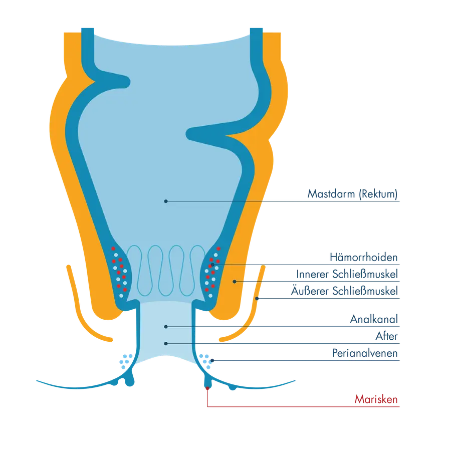 Anatomischer Querschnitt des Enddarms mit Beschriftung von Mastdarm, Hämorrhoiden, Schließmuskeln und Analkanal. Die Grafik zeigt am Afterausgang kleine, harmlose Hautläppchen, die als „Marisken“ markiert sind.