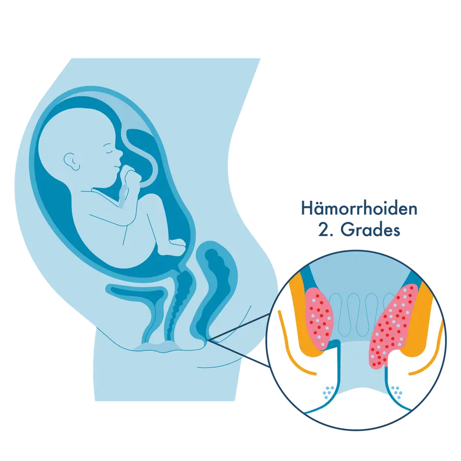 Medizinische Illustration: Links ein Querschnitt eines schwangeren Bauches mit dem Kind im Mutterleib. Rechts eine Vergrößerung des Analkanals mit stark vergrößerten Gefäßpolstern,  beschriftet als „Hämorrhoiden 2. Grades".
