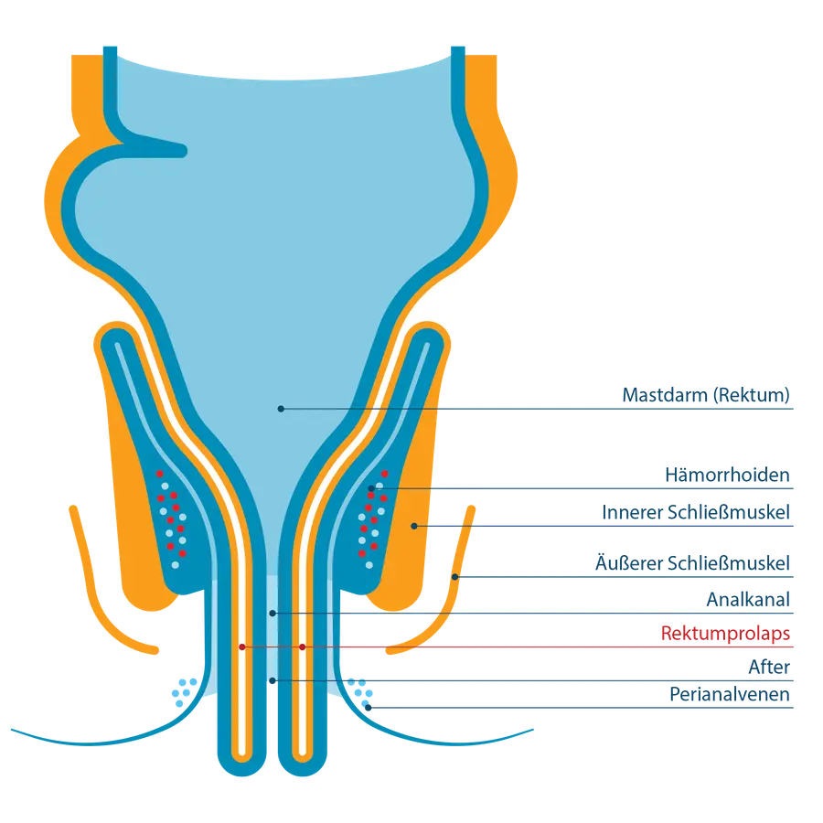 Anatomischer Querschnitt des Enddarms mit Beschriftung von Mastdarm, Hämorrhoiden, innerem und äußerem Schließmuskel, Analkanal, After und Perinalvenen. Die Darmwand fällt vollständig durch den After als Rektumprolaps heraus.