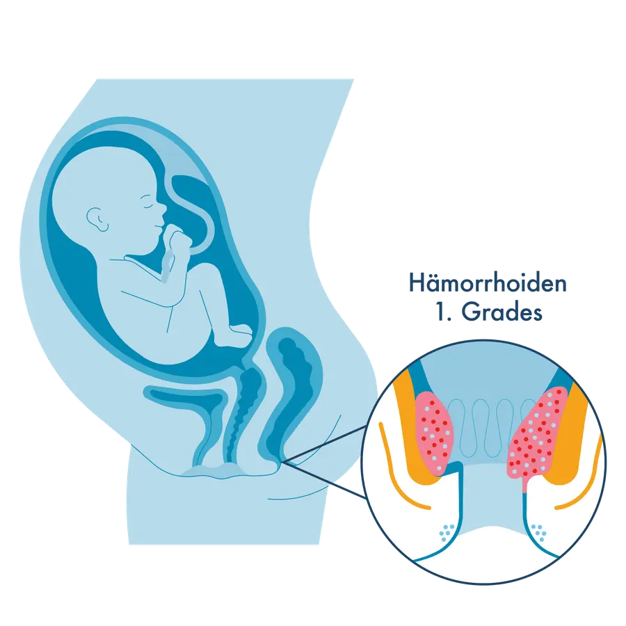 Medizinische Illustration: Links ein Querschnitt eines schwangeren Bauches mit dem Kind im Mutterleib. Rechts eine Vergrößerung des Analkanals mit leicht vergrößerten Gefäßpolstern,  beschriftet als „Hämorrhoiden 1. Grades".
