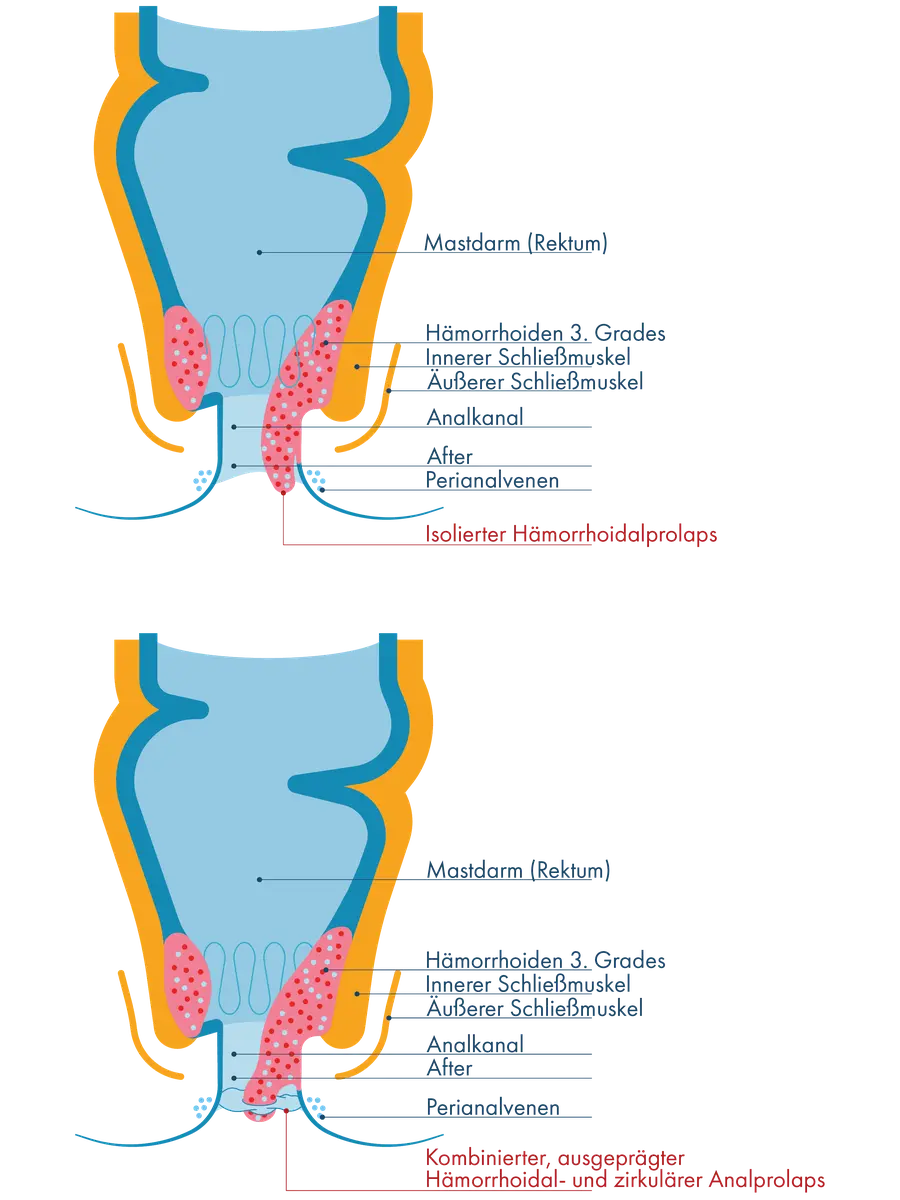 Zwei anatomische Querschnitte des Enddarms im Vergleich: Links ragen stark vergrößerte Hämorrhoiden 3. Grades als isolierter Hämorrhoidalprolaps aus dem Kanal heraus. Rechts ragen vergrößerte Gefäßpolster und ringförmig vorgefallene Schleimhaut als kombinierter Hämorrhoiden- und zirkulärer Analprolaps aus dem After heraus.