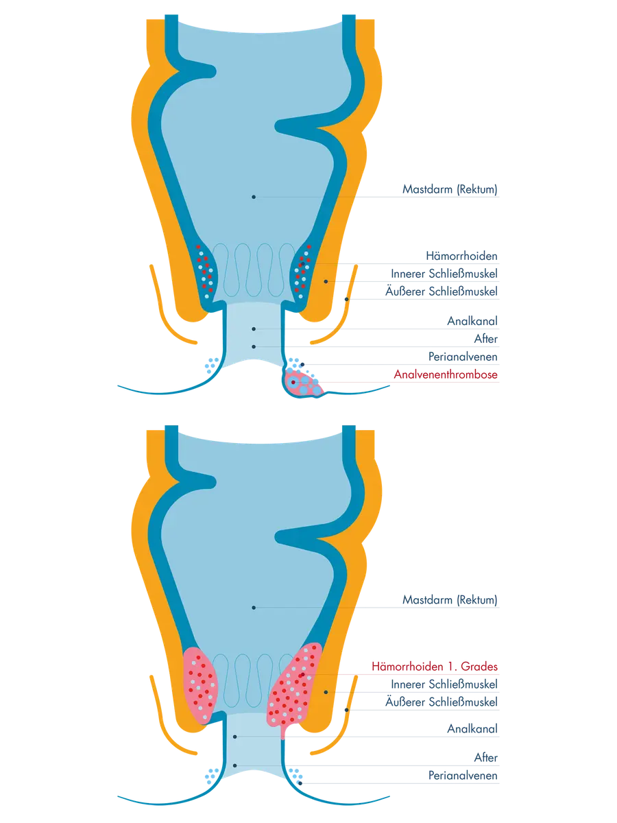Vergleichende schematische Darstellung des Enddarms: Eine Analvenenthrombose außerhalb des Analkanals im Bereich der Perianalvenen sowie Hämorrhoiden 1. Grades als innere Gefäßpolster, die nicht nach außen vorfallen.