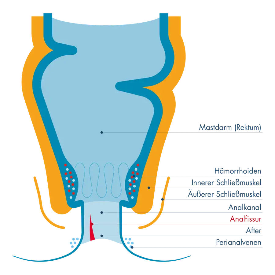 Schematische Darstellung von Mastdarm (Rektum) und Analkanal mit innerem und äußerem Schließmuskel. Im unteren Bereich des Analkanals ist eine Analfissur hervorgehoben, erkennbar als Einriss der Schleimhaut nahe dem After.