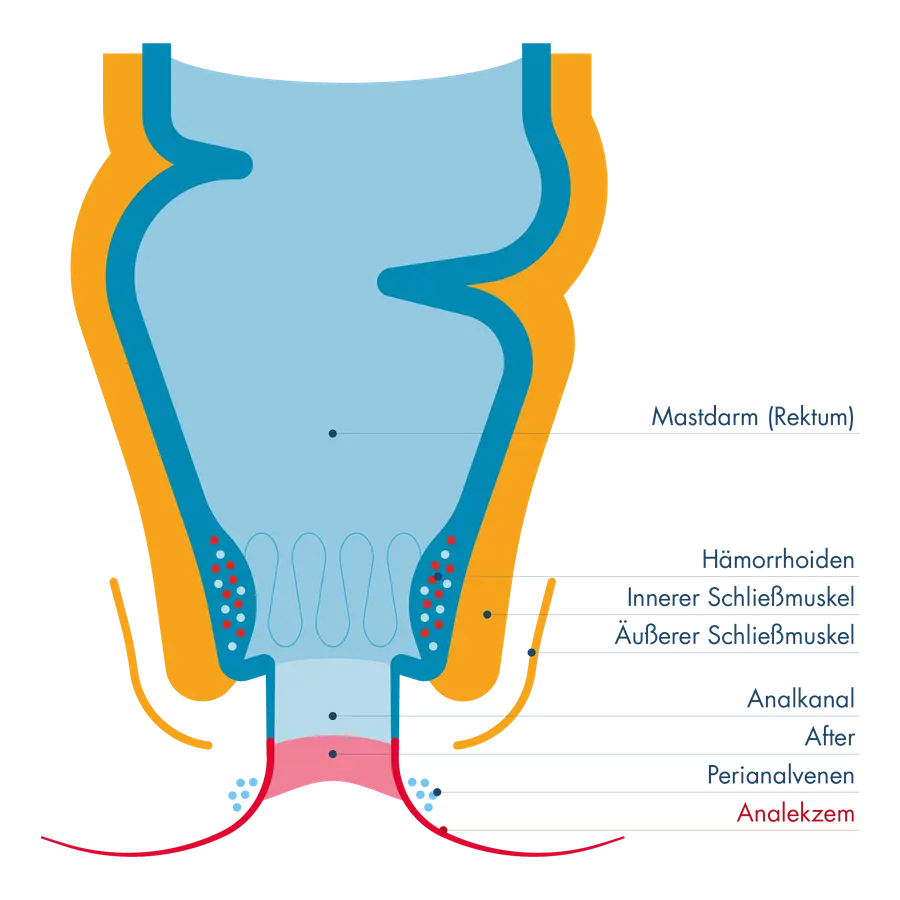 Schematischer Querschnitt des Enddarms. Von oben nach unten beschriftet: Mastdarm (Rektum), Hämorrhoiden, innerer und äußerer Schließmuskel, Analkanal, After, Perianalvenen. Das Analekzem (rot markiert) betrifft die Haut um den After und die Perianalregion.