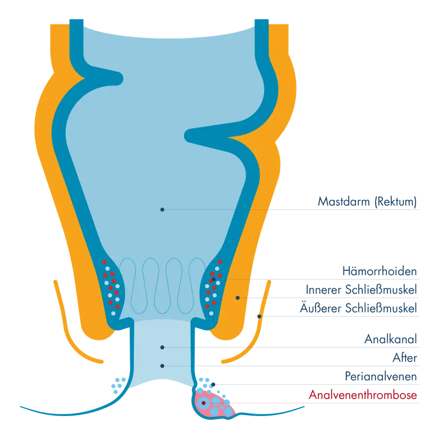 Anatomischer Querschnitt des Enddarms mit Beschriftung von Mastdarm, Hämorrhoiden, innerem und äußerem Schließmuskel, Analkanal, After und Perinalvenen. Am Ausgang des Afters ist eine Analvenenthrombose als geröteter, hervorgetretener Knoten markiert