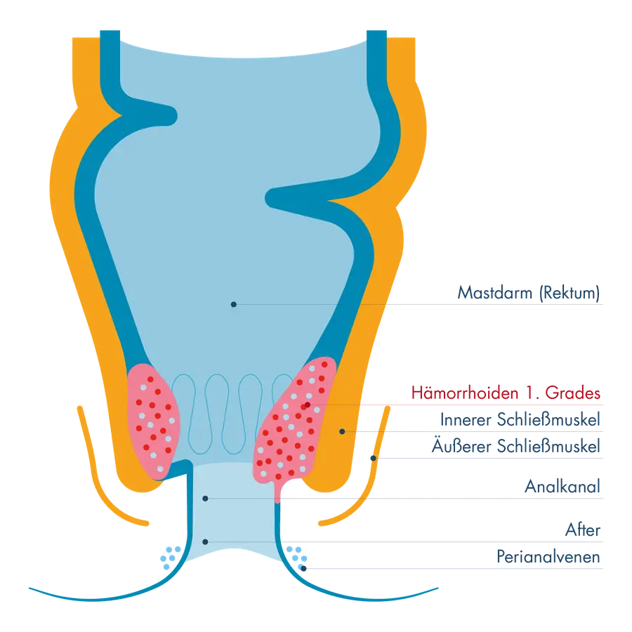 Schematische Darstellung von Mastdarm (Rektum) und Analkanal mit innerem und äußerem Schließmuskel. Hervorgehoben sind Hämorrhoiden 1. Grades, die sich als vergrößerte Gefäßpolster im Inneren des Analkanals oberhalb des äußeren Schließmuskels befinden und nicht nach außen vorfallen.