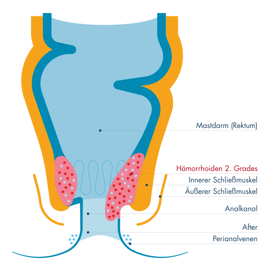 Schematische Darstellung von Mastdarm (Rektum) und Analkanal mit innerem und äußerem Schließmuskel. Gezeigt sind Hämorrhoiden 2. Grades als vergrößerte Gefäßpolster oberhalb des äußeren Schließmuskels, die vorübergehend nach außen treten, sich jedoch von selbst zurückbilden.