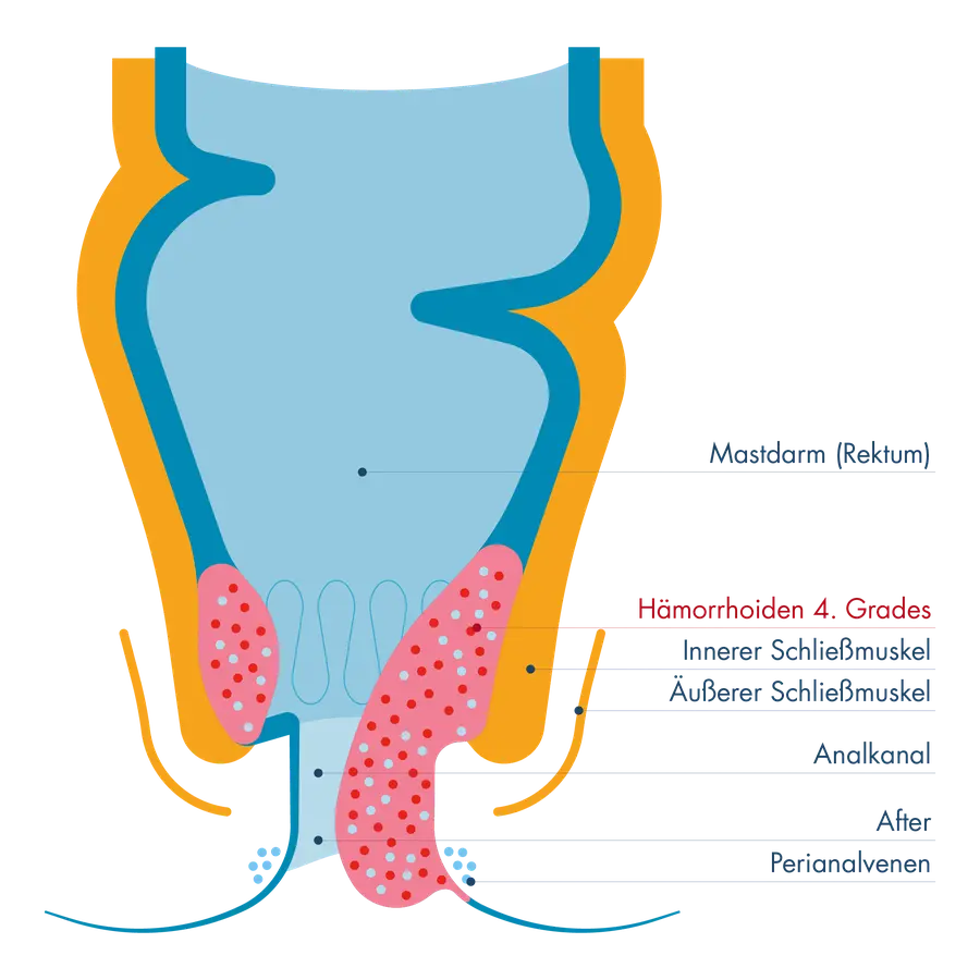 Schematische Darstellung von Mastdarm (Rektum) und Analkanal mit innerem und äußerem Schließmuskel. Hervorgehoben sind Hämorrhoiden 4. Grades als stark vergrößerte Gefäßpolster, die dauerhaft aus dem Analkanal nach außen vorgefallen sind und sich nicht mehr zurückschieben lassen.