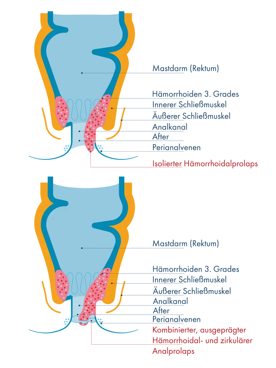 Zwei anatomische Querschnitte des Enddarms im Vergleich: Links ragen stark vergrößerte Hämorrhoiden 3. Grades als isolierter Hämorrhoidalprolaps aus dem Kanal heraus. Rechts ragen vergrößerte Gefäßpolster und ringförmig vorgefallene Schleimhaut als kombinierter Hämorrhoiden- und zirkulärer Analprolaps aus dem After heraus.