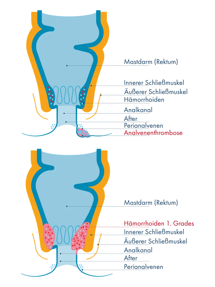 Vergleichende schematische Darstellung des Enddarms: Eine Analvenenthrombose außerhalb des Analkanals im Bereich der Perianalvenen sowie Hämorrhoiden 1. Grades als innere Gefäßpolster, die nicht nach außen vorfallen.