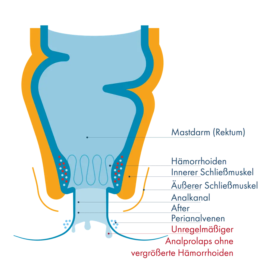 Anatomischer Querschnitt des Enddarms mit Beschriftung von Mastdarm, Hämorrhoiden, innerem und äußerem Schließmuskel sowie dem Analkanal. Am Ausgang ist ein „unregelmäßiger Analprolaps ohne vergrößerte Hämorrhoiden“ markiert, bei dem die Schleimhaut leicht nach außen tritt.
