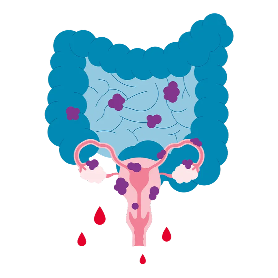 Anatomische Illustration von Darm und Gebärmutter mit Eierstöcken. Auf den Organen sitzen violette Endometrioseherde, unterhalb der Gebärmutter mehrere Blutstropfen.