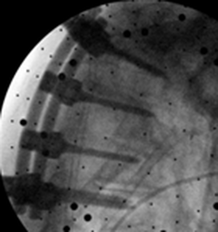 Intraoperative image of implanted hardware