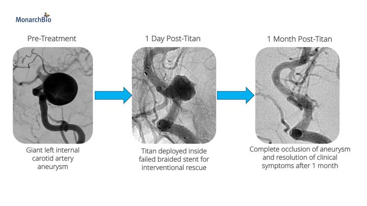 Titan stent patient imaging over time