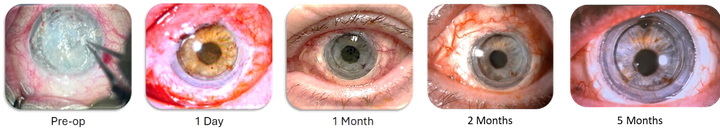 Corneal transplant images of eye over time